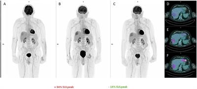 Case Report: Long-term metabolic response of metastatic uveal melanoma to pembrolizumab on FDG-PET/CT despite a serial pseudoprogressions phenomenon